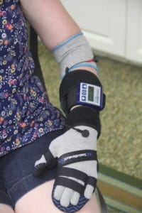 SaeboStim Micro electrical stimulation machine paired with SaeboStretch resting hand splint on a person