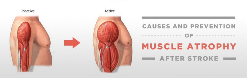 Causes And Prevention Of Muscle Atrophy After Stroke