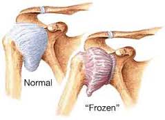 De-icing the Mystery Behind Hemiplegic Frozen Shoulder – Saebo