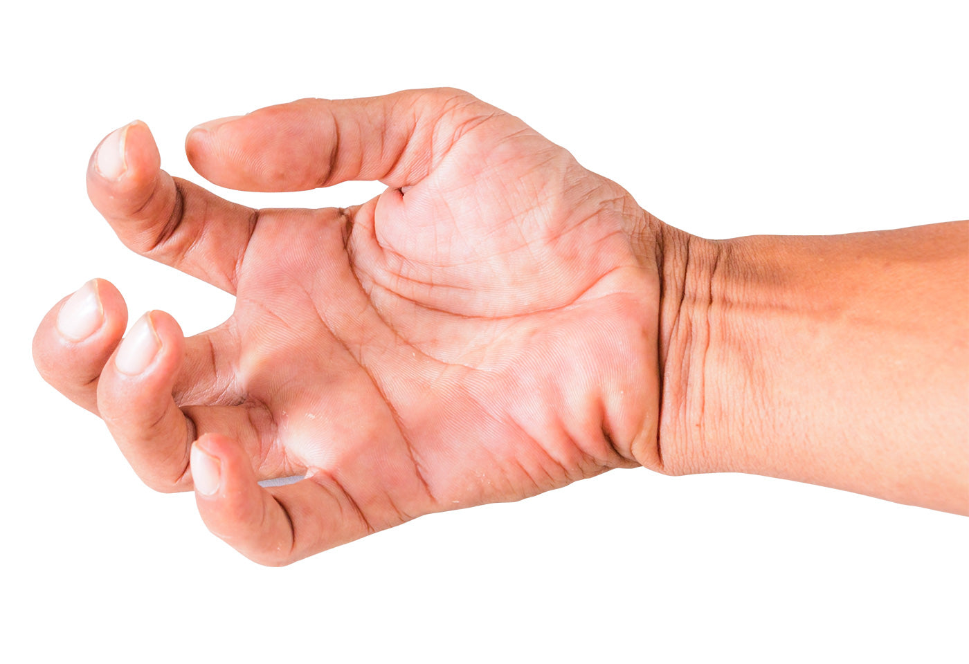 Contracture