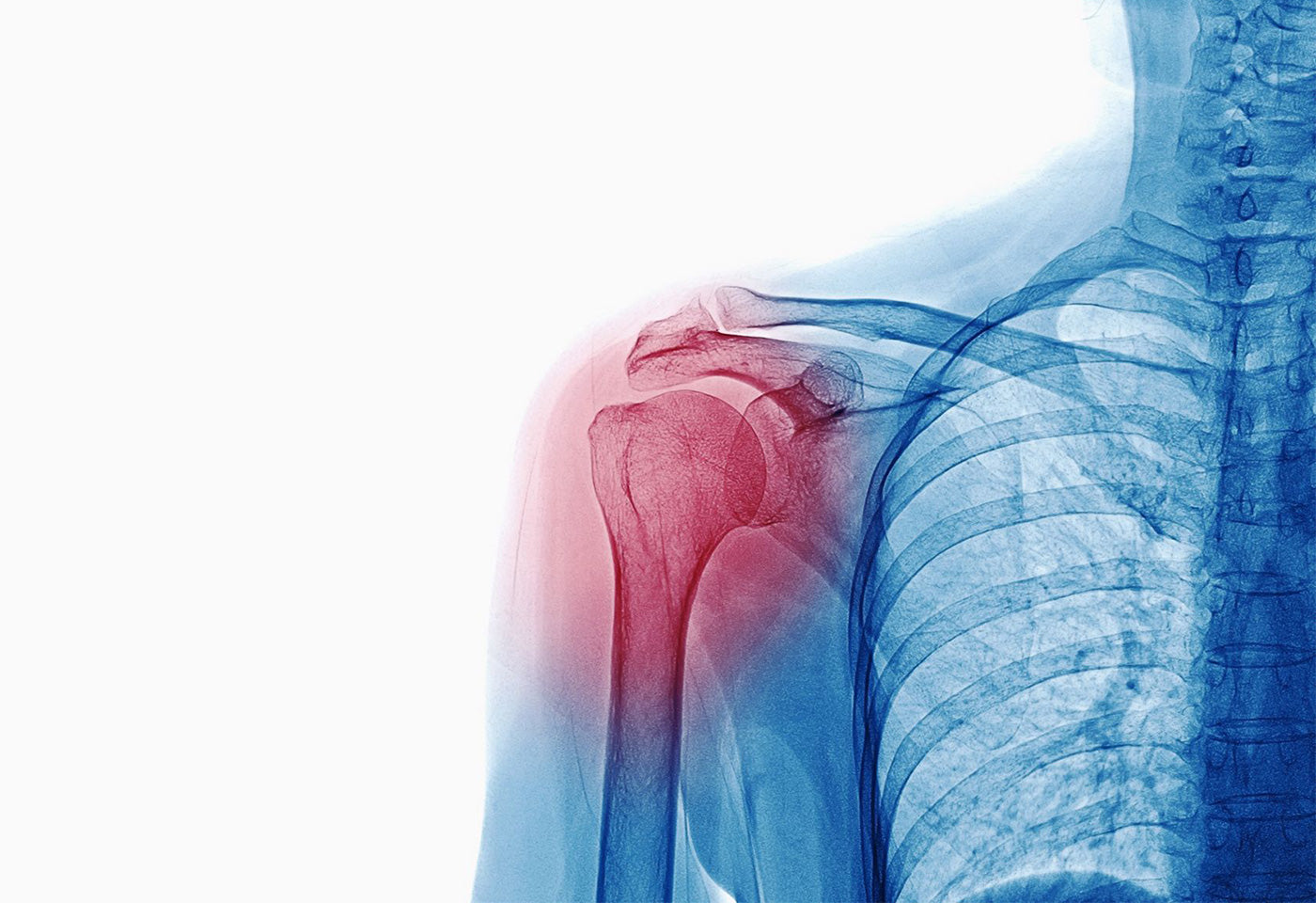 Subluxation